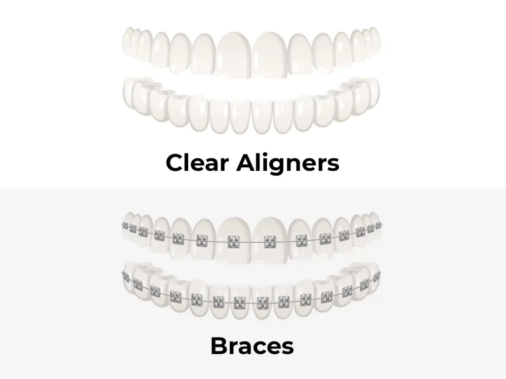 Clear Braces Vs. Clear Aligners What Is The Difference
