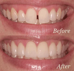Smile Designing Treatment in Coimbatore