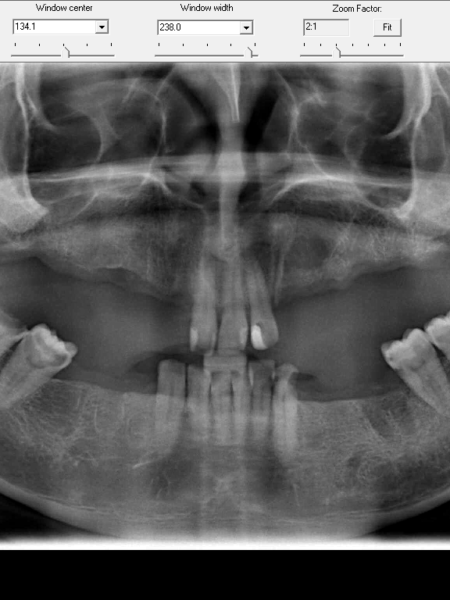 full mouth implant 1
