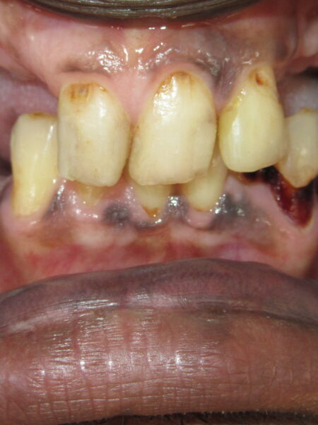 full mouth implant 2