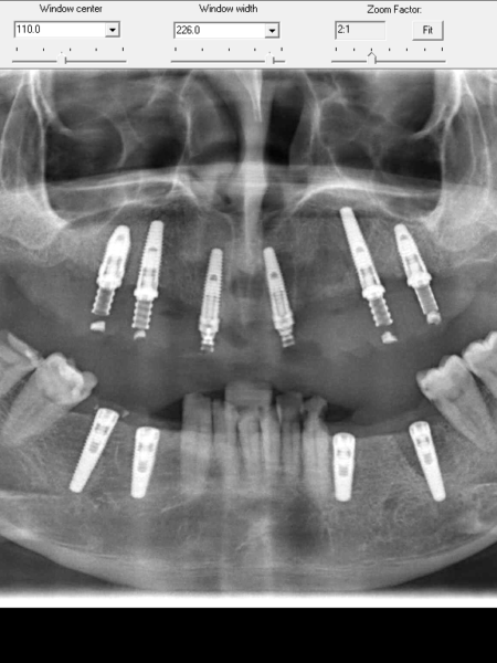 full mouth implant 2