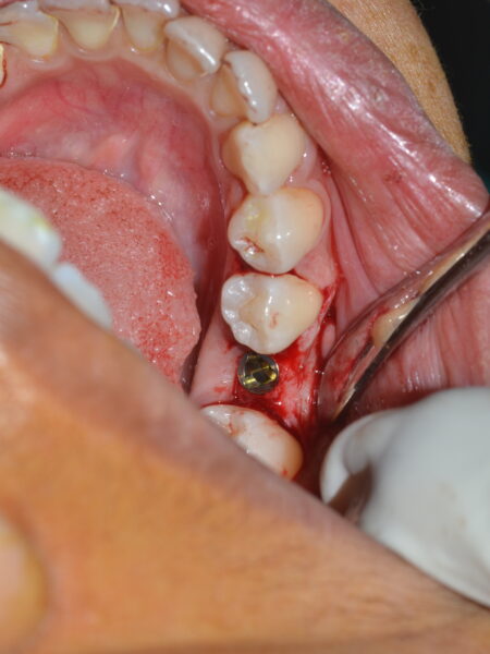 implant 1