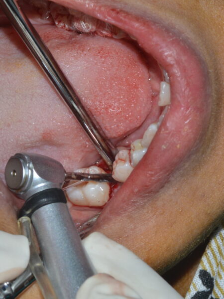 implant 2