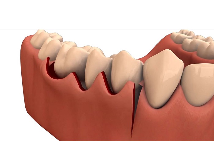 dental flap Surgery
