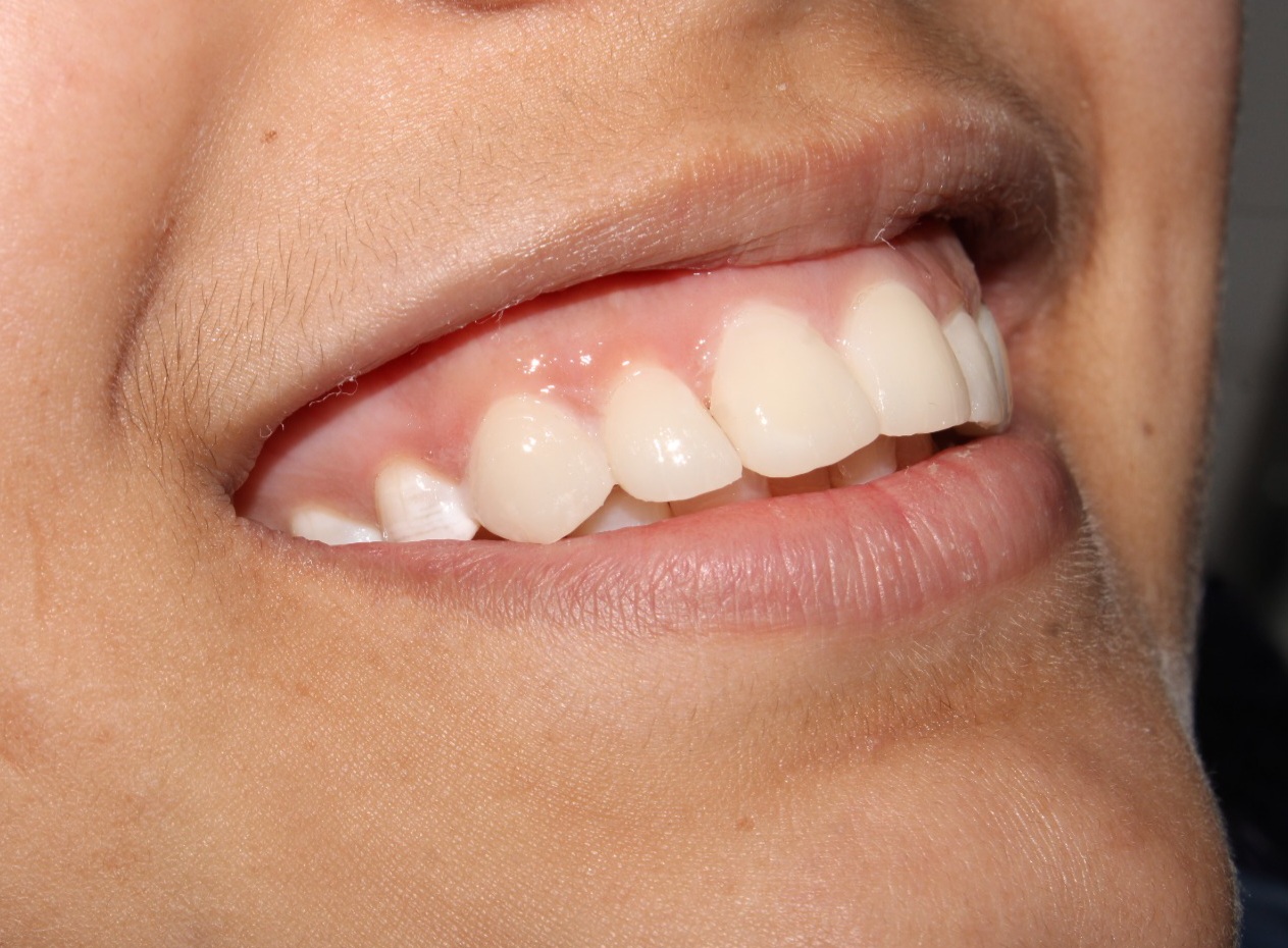 Teeth Cleaning in Coimbatore