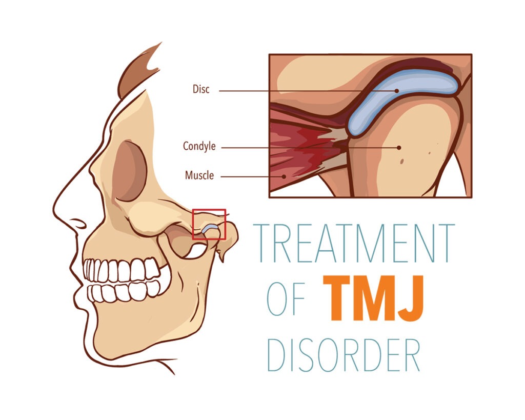 TMJ Disorder Treatment in Coimbatore