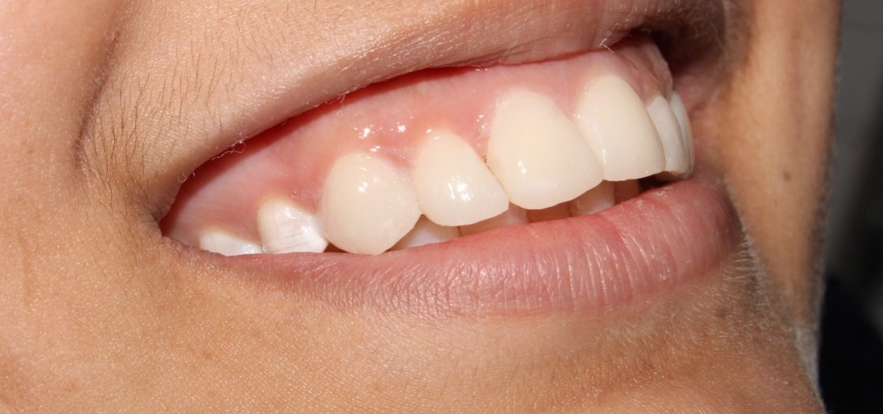 Teeth Cleaning in Coimbatore