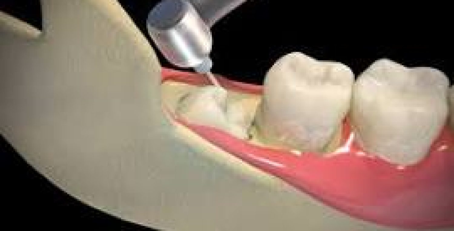 Best Wisdom Tooth Removal in Coimbatore