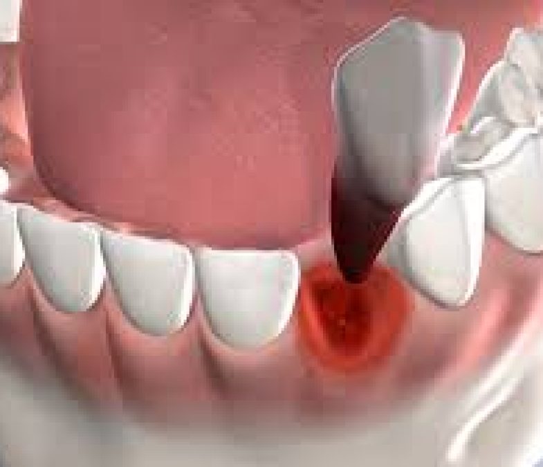 Dental Extraction